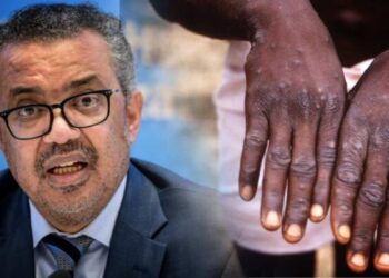 OMS declara la viruela del mono emergencia sanitaria internacional