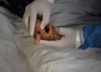 Fallece turista italiano; primer caso de viruela símica detectado en Cuba