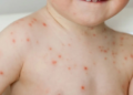Virus afecta a niños menores de 5 años en la India: Gripe del tomate