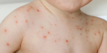 Virus afecta a niños menores de 5 años en la India: Gripe del tomate