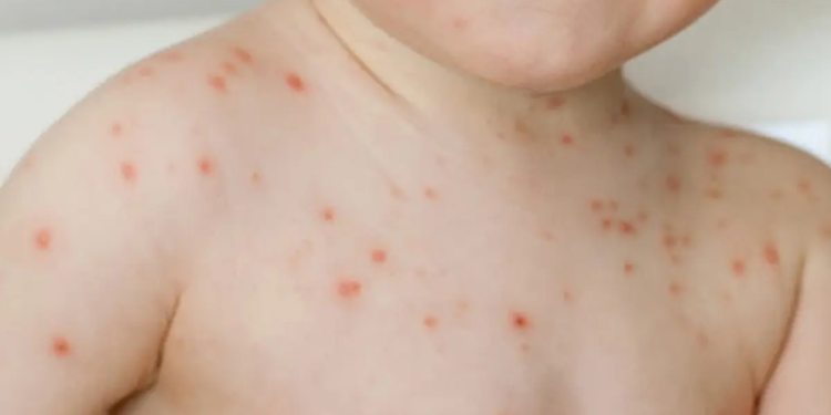 Virus afecta a niños menores de 5 años en la India: Gripe del tomate