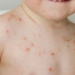 Virus afecta a niños menores de 5 años en la India: Gripe del tomate