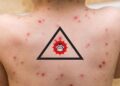 ¿Qué sabemos de la viruela del mono hasta ahora?