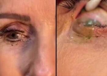 Vídeo: ¡Impactante vídeo! doctora retira más de 20 lentes de contacto a una paciente
