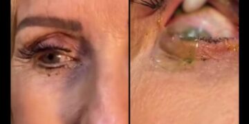 Vídeo: ¡Impactante vídeo! doctora retira más de 20 lentes de contacto a una paciente