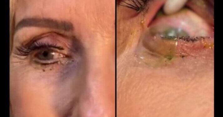 Vídeo: ¡Impactante vídeo! doctora retira más de 20 lentes de contacto a una paciente