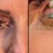 Vídeo: ¡Impactante vídeo! doctora retira más de 20 lentes de contacto a una paciente