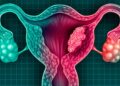 ¿Cáncer de útero por alaciarte el cabello seguido? Esto dice la ciencia
