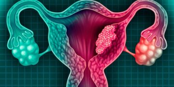 ¿Cáncer de útero por alaciarte el cabello seguido? Esto dice la ciencia