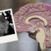 10 señales de que eres propenso a padecer Alzheimer