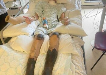VIDEO: Futbolista fue al hospital por una gripe y terminó con las piernas amputadas