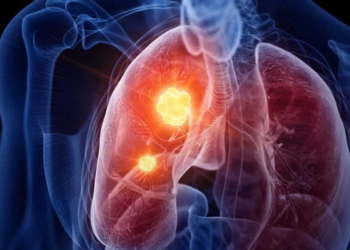 Llega a México la pastilla contra el cáncer de pulmón