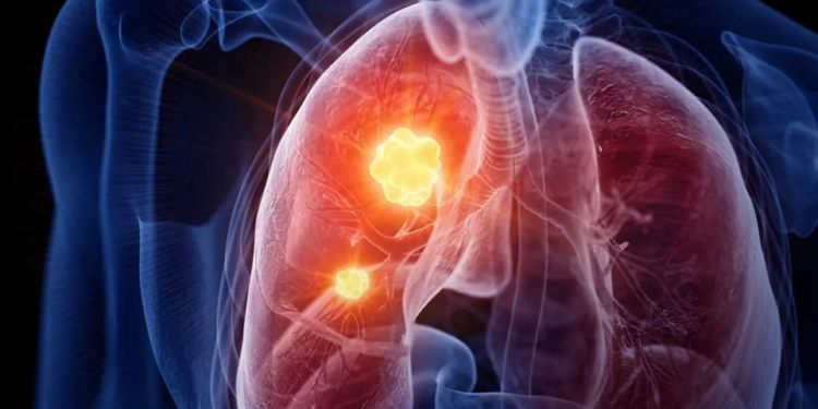 Llega a México la pastilla contra el cáncer de pulmón