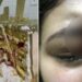 Mujer casi pierde un ojo tras darle mordida a su pastel