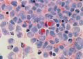 Crean nueva molécula para el tratamiento contra el cáncer
