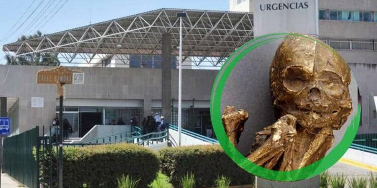 Molestia abdominal en anciana de Durango resultó ser un feto momificado