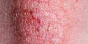 Alertan por nueva ETS por hongos altamente contagiosa