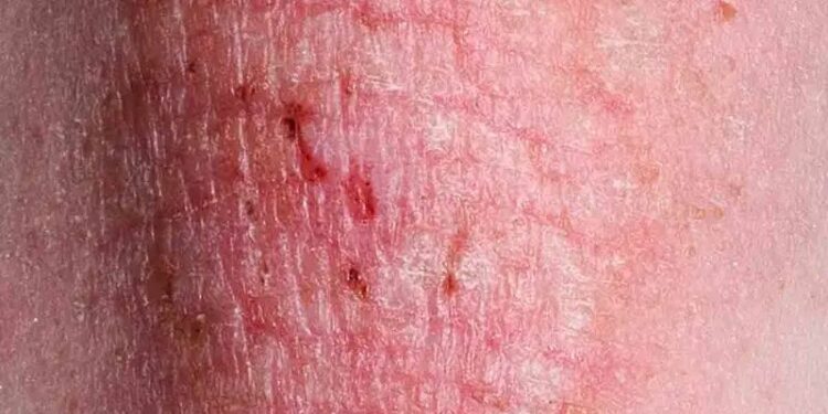 Alertan por nueva ETS por hongos altamente contagiosa