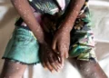 La OMS está tratando de comunicar calma frente al brote de Mpox: ‘No es la Covid’