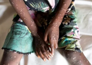 La OMS está tratando de comunicar calma frente al brote de Mpox: ‘No es la Covid’