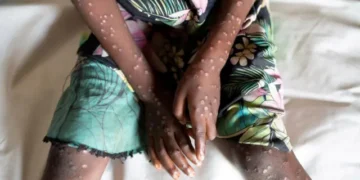 La OMS está tratando de comunicar calma frente al brote de Mpox: ‘No es la Covid’