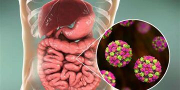 ¿Qué es la norovirus, cuáles son sus síntomas y cómo se contagia?