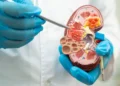 Avances en la lucha contra el cáncer de riñón avanzado gracias a vacuna experimental