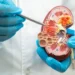 Avances en la lucha contra el cáncer de riñón avanzado gracias a vacuna experimental
