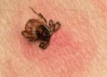 Lyme, la terrible enfermedad que tiene Justin Timberlake y cómo afecta a la salud