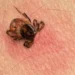 Lyme, la terrible enfermedad que tiene Justin Timberlake y cómo afecta a la salud