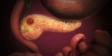 Científicos Españoles Eliminan por Completo Cáncer de Páncreas en Ratones al Combinar 3 Fármacos
