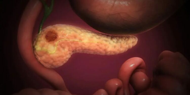 Científicos Españoles Eliminan por Completo Cáncer de Páncreas en Ratones al Combinar 3 Fármacos