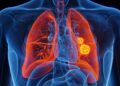 Día Mundial contra el Cáncer de Pulmón: 70% de casos en SLP se detecta en etapa avanzada