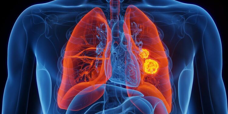 Día Mundial contra el Cáncer de Pulmón: 70% de casos en SLP se detecta en etapa avanzada