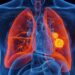 Día Mundial contra el Cáncer de Pulmón: 70% de casos en SLP se detecta en etapa avanzada