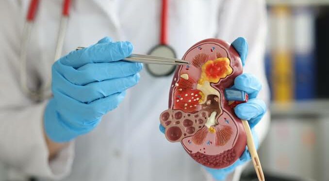Día Mundial del Cáncer de Riñón: la importancia de cuidar un órgano clave para la salud