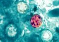 Casos de ciclosporiasis aumentan en Estados Unidos; ¿Qué es, cuáles son sus síntomas y cómo prevenirla?