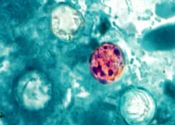 Casos de ciclosporiasis aumentan en Estados Unidos; ¿Qué es, cuáles son sus síntomas y cómo prevenirla?