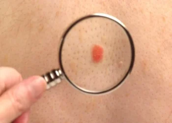 ¿Cómo funciona la primera vacuna “personalizada” contra el cáncer de piel que avanza hacia su aprobación?