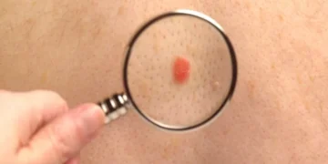 ¿Cómo funciona la primera vacuna “personalizada” contra el cáncer de piel que avanza hacia su aprobación?