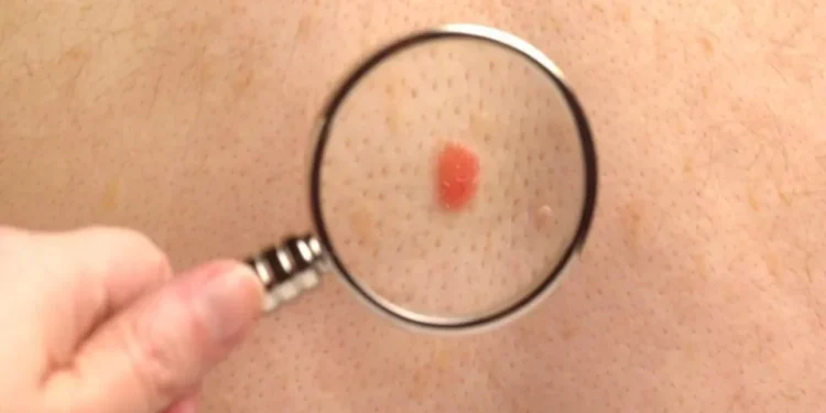 ¿Cómo funciona la primera vacuna “personalizada” contra el cáncer de piel que avanza hacia su aprobación?