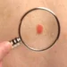 ¿Cómo funciona la primera vacuna “personalizada” contra el cáncer de piel que avanza hacia su aprobación?