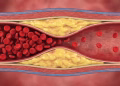 El condimento que daña silenciosamente las arterias, según cardiólogos