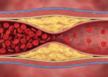 El condimento que daña silenciosamente las arterias, según cardiólogos
