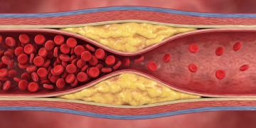 El condimento que daña silenciosamente las arterias, según cardiólogos