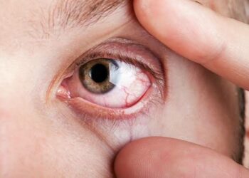 Entiende por qué ocurren los derrames oculares y descubre cuáles son las señales de alerta que exigen atención médica