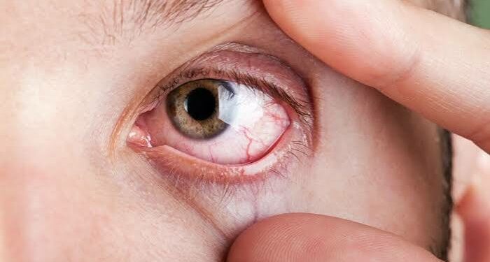Entiende por qué ocurren los derrames oculares y descubre cuáles son las señales de alerta que exigen atención médica