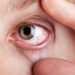 Entiende por qué ocurren los derrames oculares y descubre cuáles son las señales de alerta que exigen atención médica