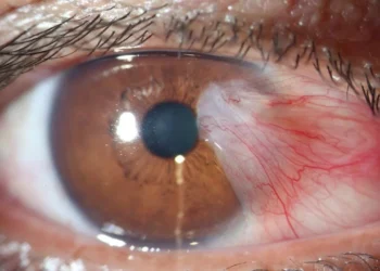 La contaminación del aire eleva el riesgo de glaucoma y cataratas, alertan estudios recientes