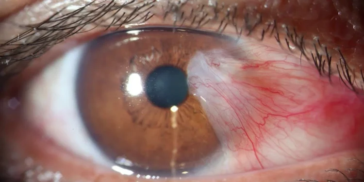 La contaminación del aire eleva el riesgo de glaucoma y cataratas, alertan estudios recientes